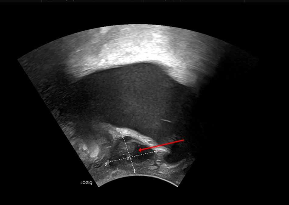 Suburethrale Raumforderung Suburethrale Raumforderung