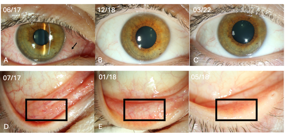 Spaltlampenbilder und Bindehaut Spaltlampenbilder und Bindehaut