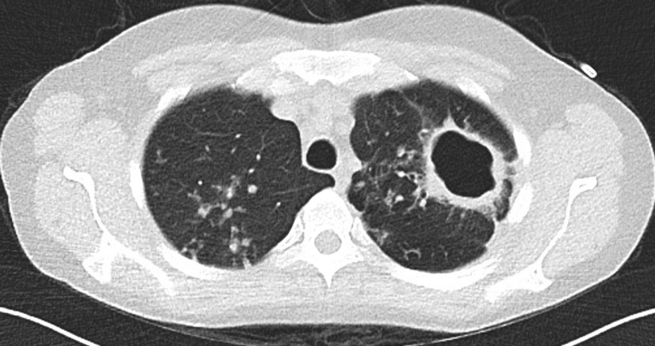 CT-Thorax