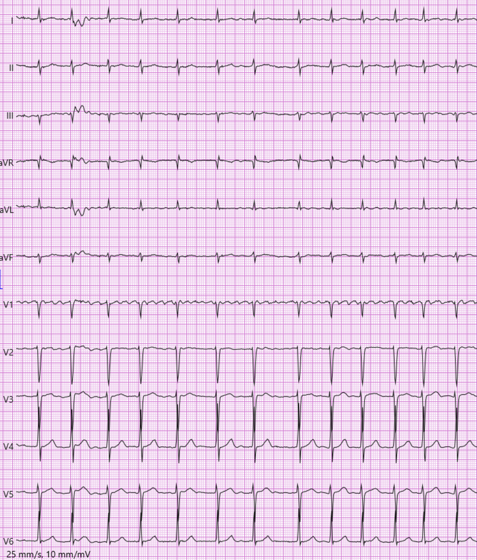 EKG der in der Kasuistik beschriebenen Patientin EKG der in der Kasuistik beschriebenen Patientin